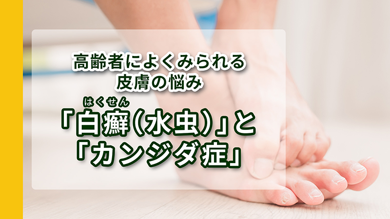 高齢者も悩む白癬とカンジタ