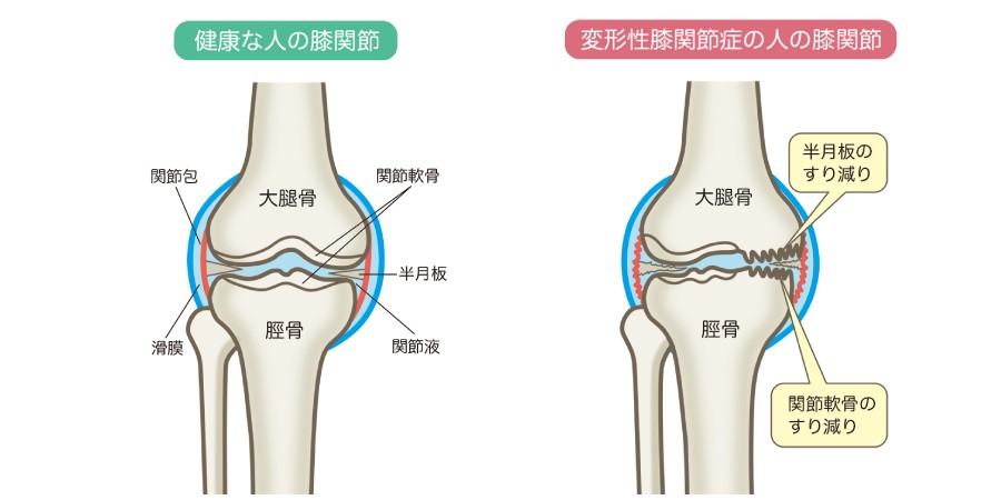 健康な人と変形性膝関節症の比較