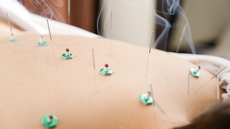 背中の痛みを鍼灸で取り除く高齢者